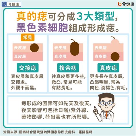 臉上為什麼會長痣|是痣？皮膚癌？還是什麼？常見Q&A解惑！醫教揪出「。